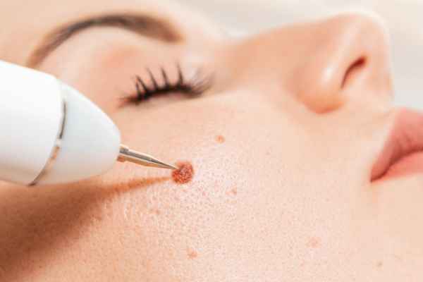 CryoPen: 5 Skin Concerns It May Be Used to Treat 3 What actually happens during a CryoPen treatment Birmingham?