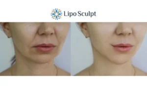 Explaining Total Skin Tightening Treatment And What It Can Do For You 2 Do you want to boost your self confidence? Give Morpheus8 Birmingham a try today!