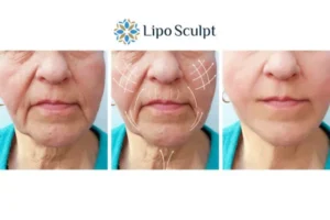 Explaining Total Skin Tightening Treatment And What It Can Do For You 3 Boost your confidence with Morpheus8 Birmingham call our team today!