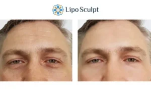 Explaining Total Skin Tightening Treatment And What It Can Do For You 6 Morpheus8 Birmingham book in today to find out more!