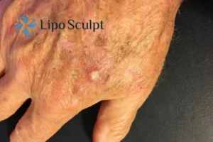 Best Actinic Keratoses Removal 2 Improve your wellbeing and health with Actinic Keratoses Birmingham removal.treatment