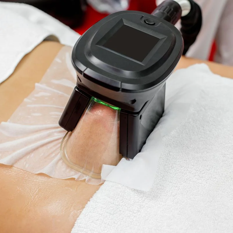 Fat Freezing treatment Birmingham